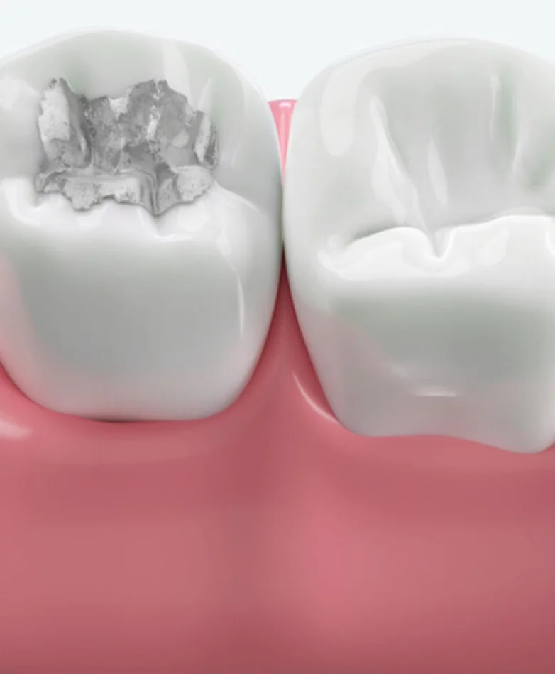 Dental Filling Types